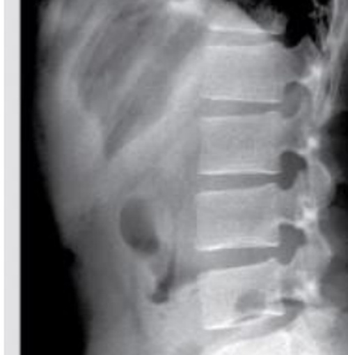 Abdominal X-ray