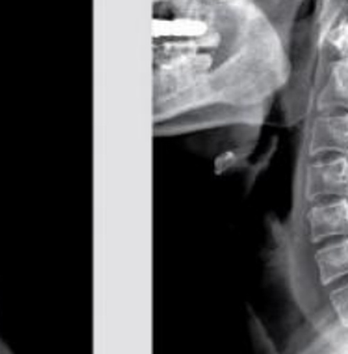 Leg X-ray with Implant